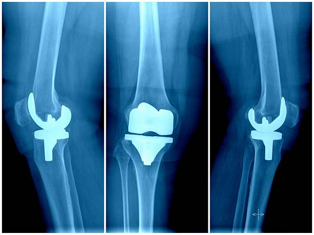 Exactech knee recall lawsuit